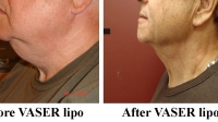 pt 136: VASER of male neck by Dr. David