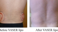 pt 138: VASER of male flanks by Dr. David