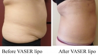 pt 139: VASER lipo of abdominal fat with a panniculus (overhang)