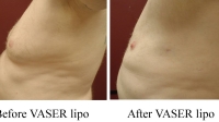 pt 140: VASER of male chest by Dr. David