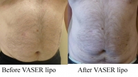 pt 141: VASER reduction by Dr. David of male abdomen by Dr. David