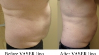 pt 142: Early results of VASER of man's abdomen. Subsequently he reduced even more
