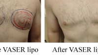 pt 143: Chest VASER by Dr. David