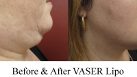 pt 144: VASER of woman's neck by Dr. David