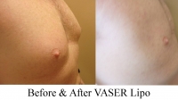 pt 15: VASER of gynecomastia by Dr. David