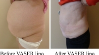 pt 151: VASER of a woman's large abdomen by Dr. David