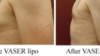 pt 155: VASER of mild gynecomastia by Dr. David