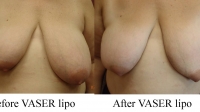 pt 156:VASER minimally invasive breast reduction in a woman with uneven breasts-- by Dr. David. She was so uneven that she couldn't even wear a bra.