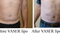 pt 157: VASER of male lower abdomen by Dr. David