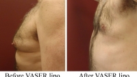 pt 158: VASER of male chest by Dr. David