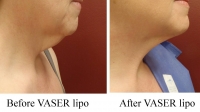 pt 159: VASER of woman's neck by Dr. David (side view)