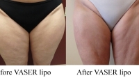 pt 161: VASER by Dr. David of outer thighs and front of the thighs ONLY. Front view