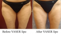 pt 163: VASER of OUTER THIGHS ONLY (by Dr. David)