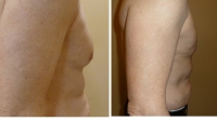 pt 166: VASER of male chest by Dr. David