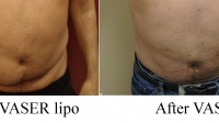pt 169: VASER treatment by Dr. David to smooth out massive scar tissue in a man's abdomen, who presented to me after prior treatment This was only 2 weeks after the VASER and not his final results. Full results in a case like this is after 3-4 months..