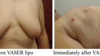 pt 17: VASER by Dr. David of extremely severe gynecomastia in a man.The "after picture was taken at the end of the procedure, with patient still on the table (notice incisions still open)