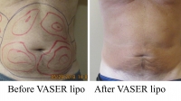pt 171: VASER of male abdomen and flanks by Dr. David