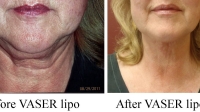 pt 175: VASER of woman's neck with irregular contour.more so than fat. The VASER was able to make her nice and smooth