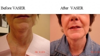 pt 179: VASER of woman's neck by Dr. David