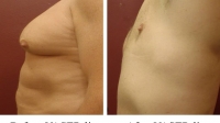 Pt 18: VASER of Severe Gynecomastia by Dr. David