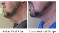 pt 180: VASER of "turkey neck" by Dr. David. This patient came up from Florida for me to do his VASER. His wife (who's a prominent surgeon) said "he now looks like he did 30 years ago when I first met him!" This is only 9 days after his VASER. He reduced even more, as time went on.