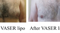 pt. 181: VASER Lipo of gynecomastia by Dr. David