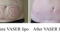 pt 182: VASER of small amount of abdominal fat by Dr. David