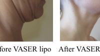 pt 183: VASER of neck (side view) by Dr. David