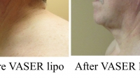 pt 184: VASER of neck (side view) by Dr. David