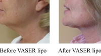 pt 185: VASER of Neck by Dr. David