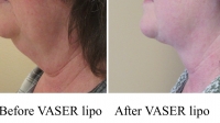 pt 186: VASER of neck by Dr. David