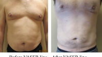 pt 187: VASER of male chest & abdomen by Dr. David