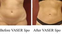 pt 188: VASER of female abdomen by Dr.David