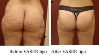 pt 189: VASER of a woman's hips and outer thighs by Dr. David