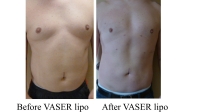 VASER of chest, abdomen & Love Handles by Dr. David. Dark entry points still visible here, lightened up soon after the picture was Scar by his navel was from previous umbilical hernia repair elsewhere.