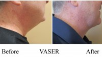 pt-191:  VASER of male neck by Dr. David. Side View