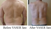 Pt 2: VASER of love handles by Dr. David