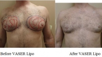 pt 20: VASER of gynecomastia by Dr. David