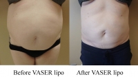 pt 21: VASER lipo (by Dr.David) of woman with large abdomen