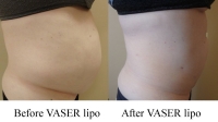 pt 22: VASER by Dr. David, of woman with large protuberant abdomen