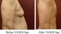 pt 27: VASER of male chest and abdomen by Dr. David