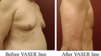 pt 28: VASER of male chest and abdomen by Dr. David