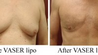 pt 29: VASER of male chest and abdomen by Dr. David