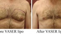 pt 30: VASER of male chest by Dr. David