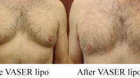 pt 32: VASER of gynecomastia by Dr. David