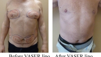 pt 33: VASER of male chest and abdomen by Dr. David