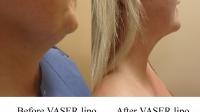 pt 38: VASER of woman's neck by Dr. David