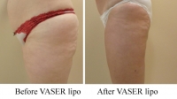 pt 39: VASER of a woman's thighs by Dr. David