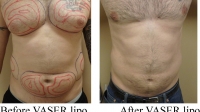 pt 41: VASER of a man's chest, abdomen and love handles by Dr. David