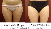 pt 42: VASER of outer thighs (only) and love handles by Dr. David. Inner thighs were NOT treated.